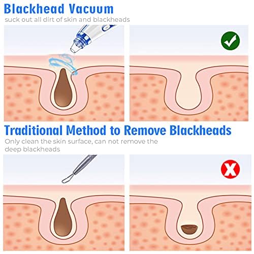 Blackhead Remover Pore Vacuum Pore Cleaner Comedone Whitehead Extractor Tool-5 Suction Power,5 Probes,USB Rechargeable Blackhead Vacuum Kit