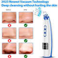 Blackhead Remover Pore Vacuum Pore Cleaner Comedone Whitehead Extractor Tool-5 Suction Power,5 Probes,USB Rechargeable Blackhead Vacuum Kit